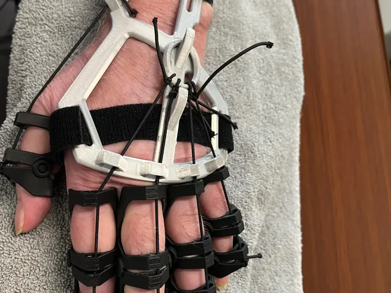 Custom dynamic hand orthosis with finger loops fitted to a patient