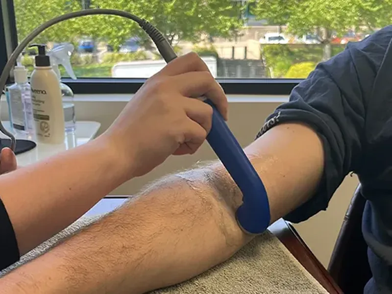 Silicone cupping applied to a patient&rsquo;s forearm during a soft tissue session