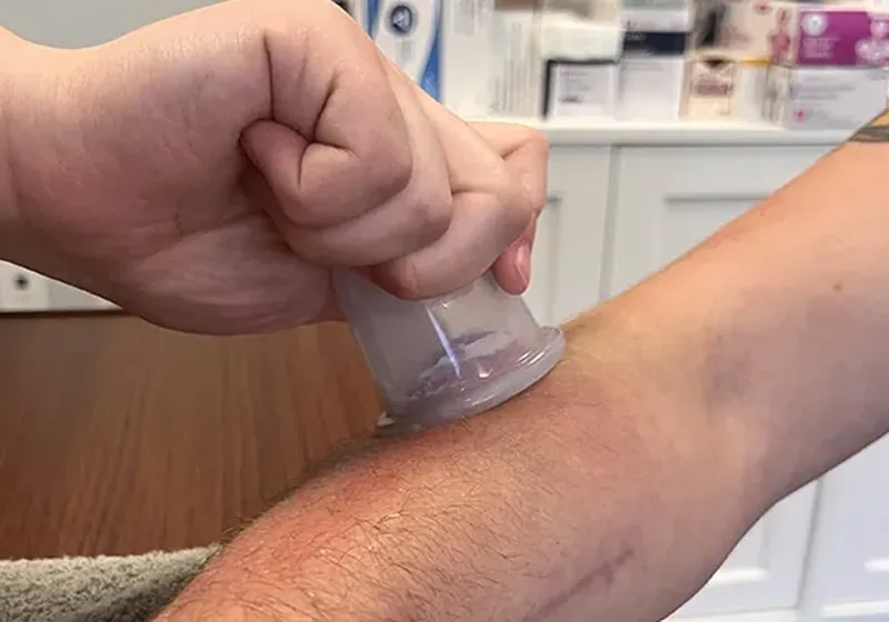 Silicone cupping applied to a patient's forearm